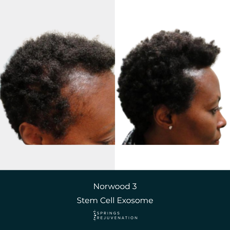 Norwood 3 Stem Cell Exosome